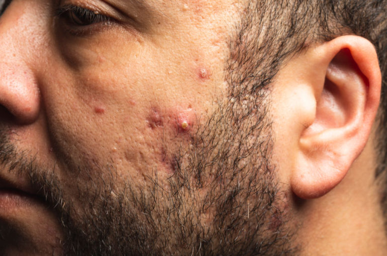 Hoe steroïde acne te verminderen?